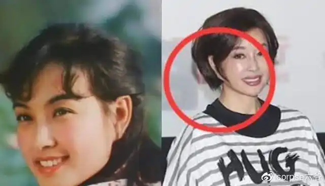 整形医院院长曝刘晓庆拉皮手术失败左右脸不对称耳垂畸形