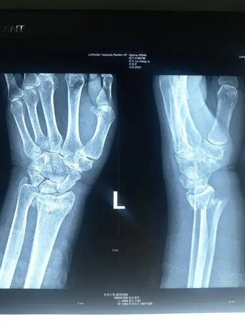 colles骨折的保守治疗体会!