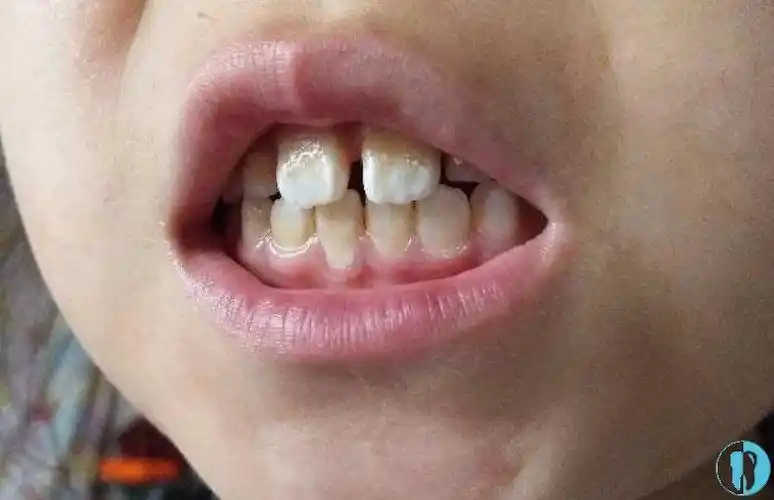 我保持器戴了三年还反弹嘴更凸 - 口腔资讯 - 牙齿矫正网