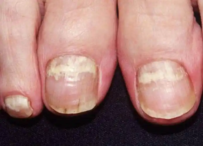 甲真菌病(灰指甲)