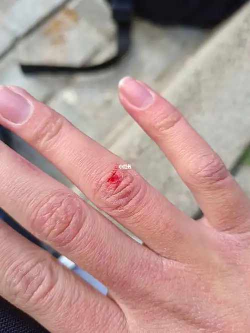 这样子的一个小伤口流了快四十分钟的血