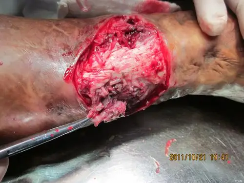 很难遇见的病例,腿上长蛆了