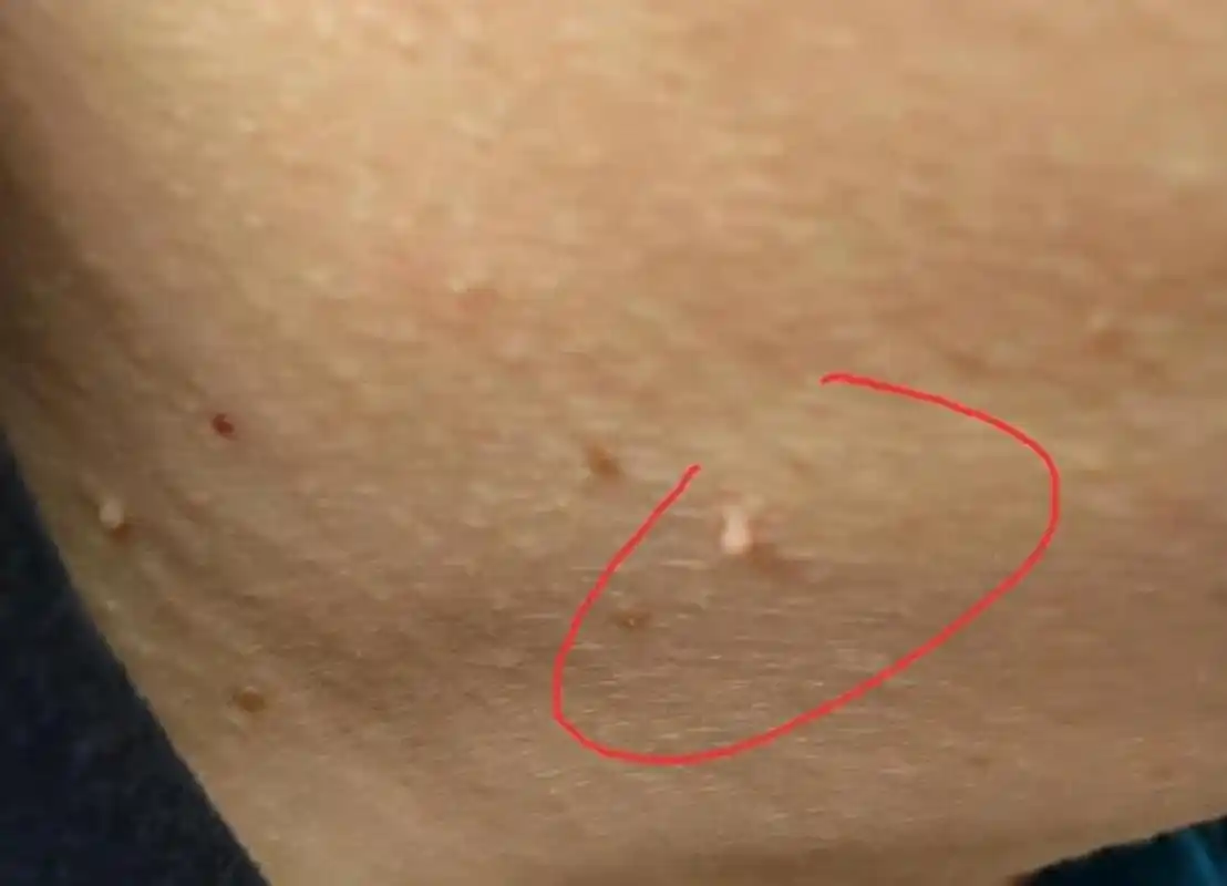 脖子上的小疙瘩竟然是hpv?