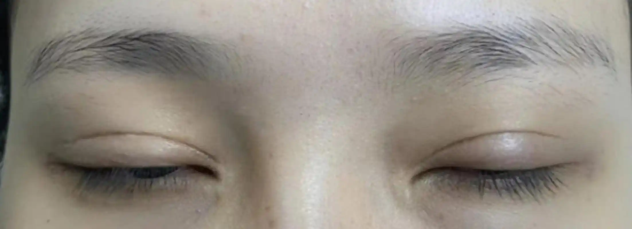 为什么做完双眼皮后,闭眼疤痕会很明显? 可能是这三个原因,注意了!