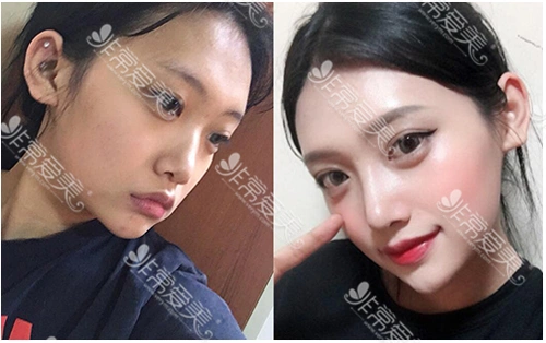 普瑞美医院隆鼻对比图