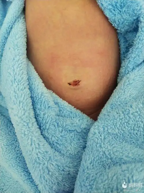 宝宝一周的时候脐带就脱落了然后第八天的时候我把纱布 | 妈妈网轻聊