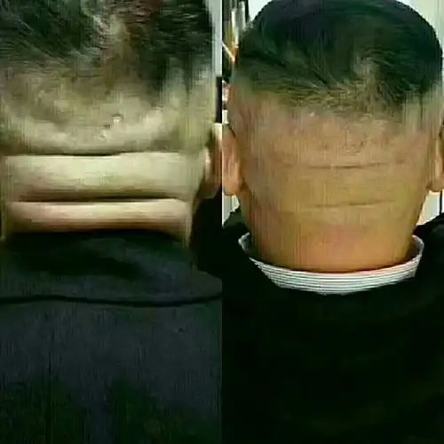 后脑勺有"堆肉"是怎么回事?这样的脑后"堆肉"对身体有什么危害吗?