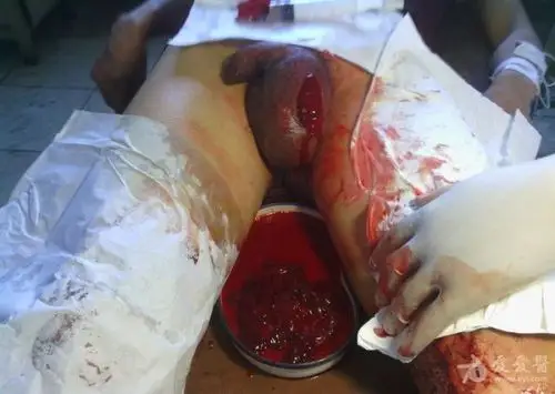 武某某 男 31岁 自切睾丸一例