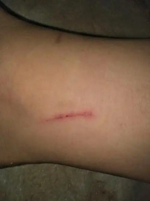 这个我得脚这儿莫名其妙出现了伤口.