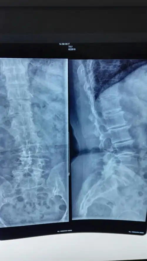 腰椎侧弯伴重度椎管狭窄手术一例