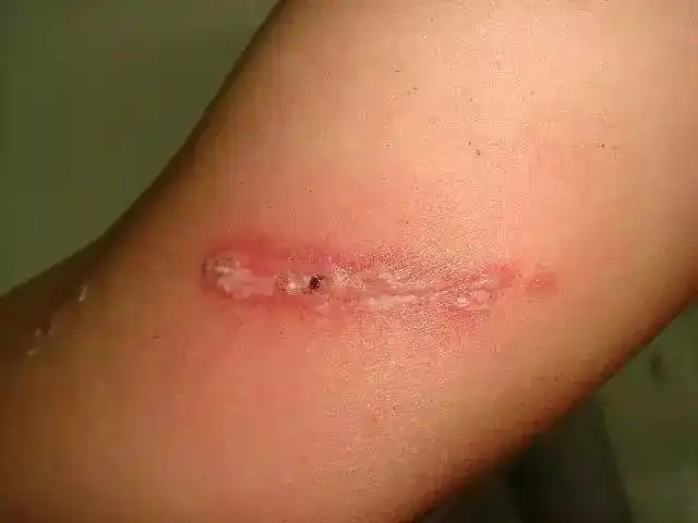 当心这种虫飞到脸上别用手拍好多十堰人毁容