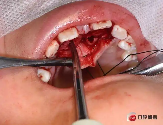 局麻与全麻的抉择微创无痛拔除上颌腭部埋伏多生牙