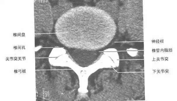 正常脊柱脊髓ct解剖-人体解剖图