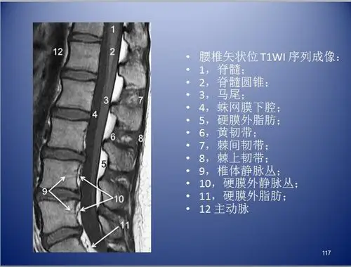 脊柱ct,mr断层解剖2