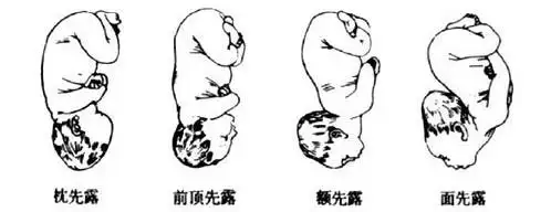 胎位不正的三种类型