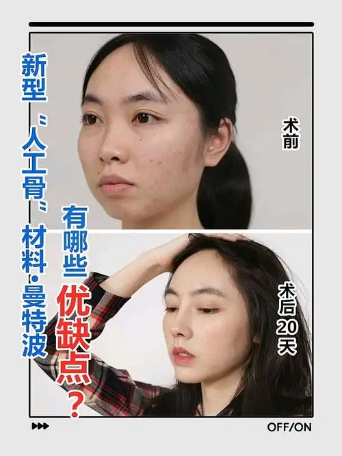 它的应用对于那些不愿意取肋软骨,又希望鼻头抬高,鼻小柱延长等问题