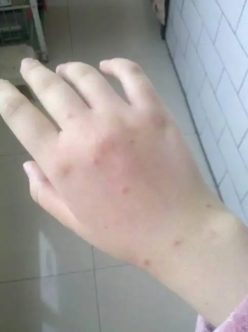 是水土不服引起的过敏吗?吃药抹药怎么都不管用?