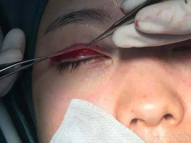 【讨论】经睑缘切口重睑术