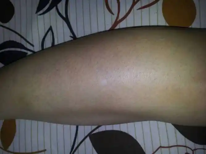 小腿长了个白点,两三年了请大家看看是什么?