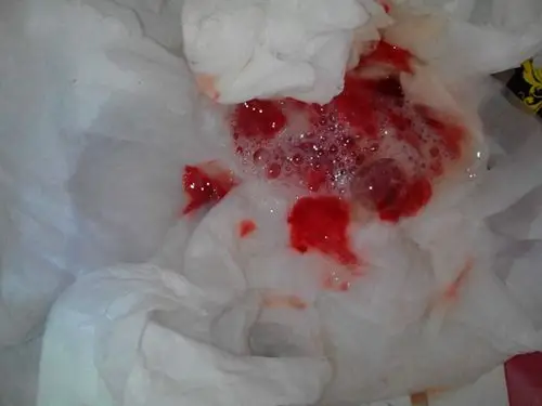 吐血图片 (3)_有来医生