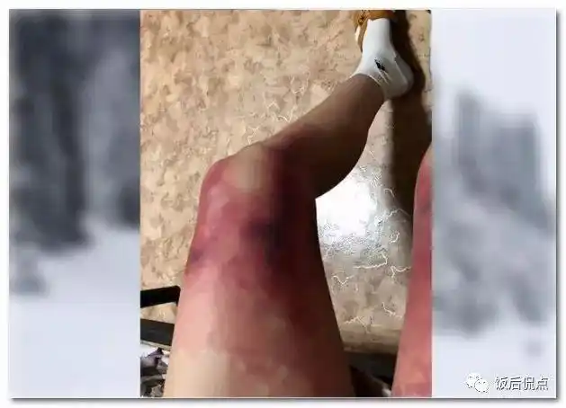 哈萨克女子大腿冻伤求医,零下40度穿短裙街头散步!