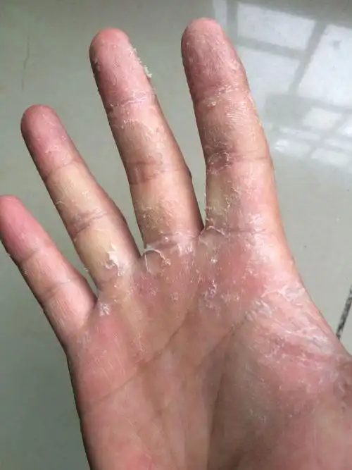 手气,真菌感染,前几天发现手上起小白点痘痘,还很痒,也没在意,结果几