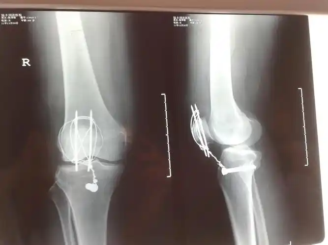 髌骨骨折.这样有错吗.