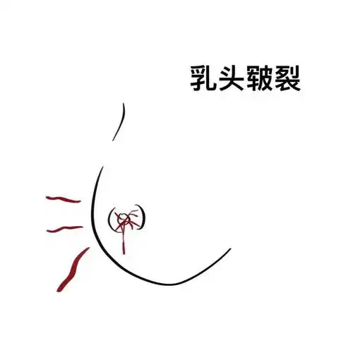 5,乳头皲裂哺乳时,宝宝不正确的吸吮姿势,或喂完后将宝宝移开时不小心