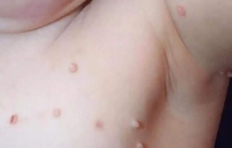 她身上这些疙瘩是尖锐湿疣,化验报告显示,她是感染了高危型hpv病毒才