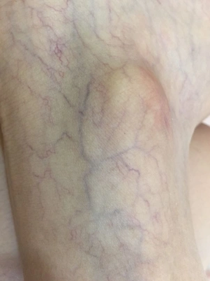 网状青斑 (49)_有来医生