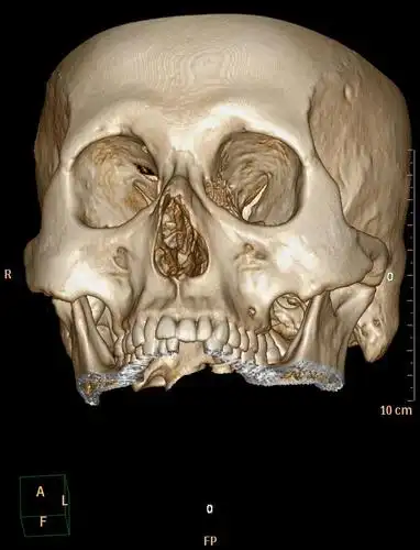 ct51740:鼻骨ct,请会诊!
