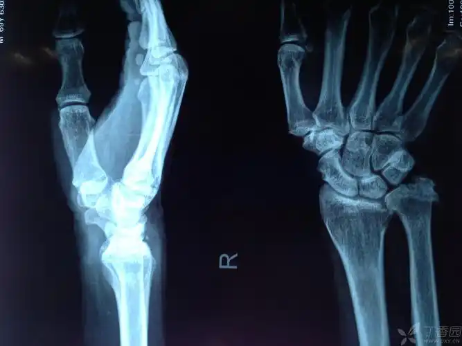 尺骨茎突不明增生···尺骨茎突撞击综合征?