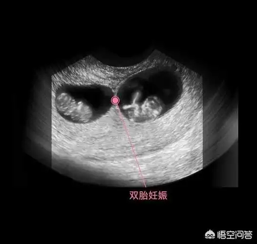 头条问答 - 一个孕囊两个胚芽,是双胞胎吗?(37个回答)