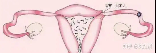 怎么知道自己的输卵管堵塞了
