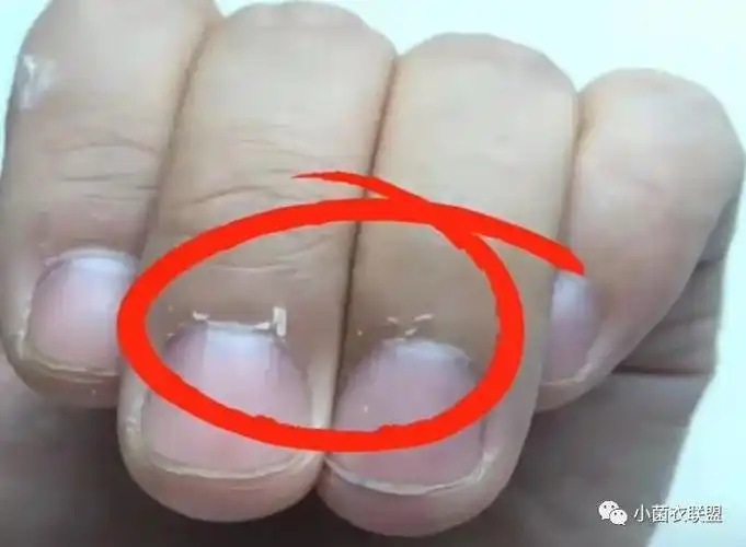 倒刺随意拔,后果很严重_身体_澎湃新闻-the paper