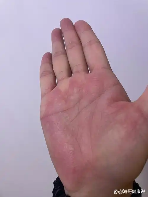 手掌发红发痒