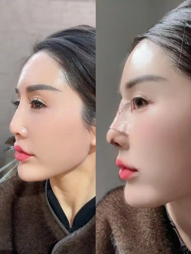 本人隆鼻前后对比#做完鼻子后的改变