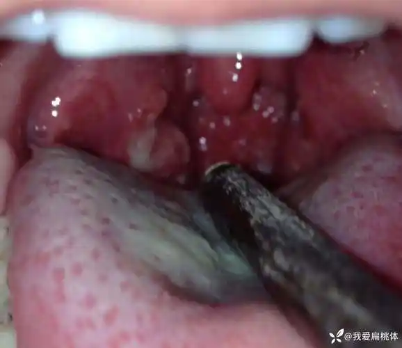 扁桃体化脓喙治治疗可能终身慢性扁桃体炎