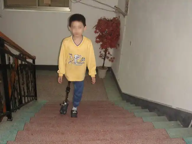 髋离断大腿假肢装配案例