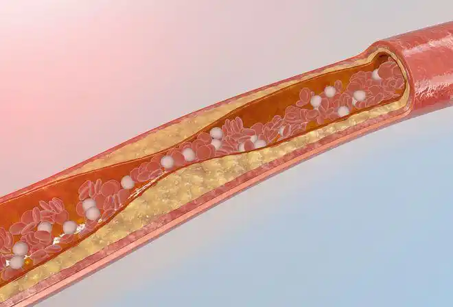 动脉硬化是如何形成的这几点不注意疾病找上门