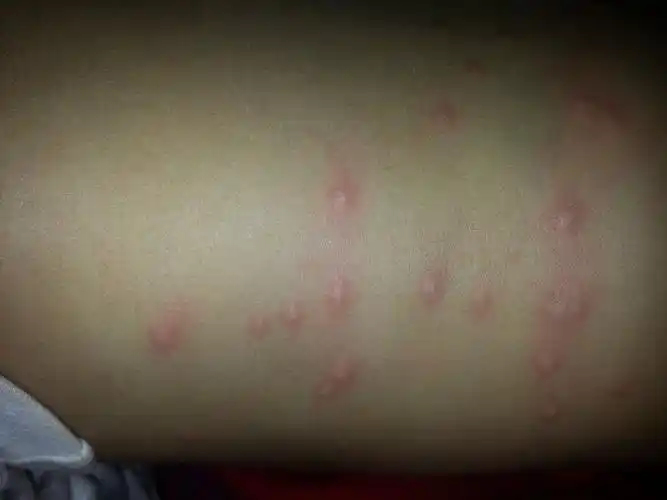 宝宝1岁半了 身上起的红色疙瘩