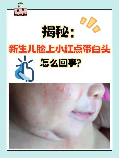 宝宝脸上起小红疹子是什么原因新生儿痤疮新生儿脸上有小红疹子是什么