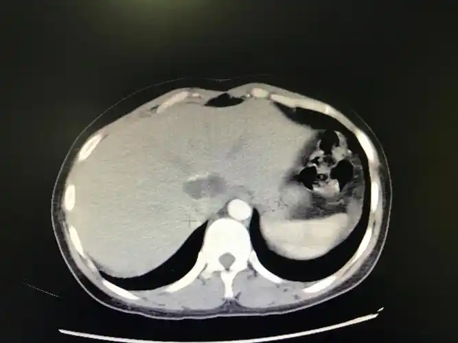 用针做手术--超声引导下穿刺抽吸联合微波消融治疗肝囊型包虫病