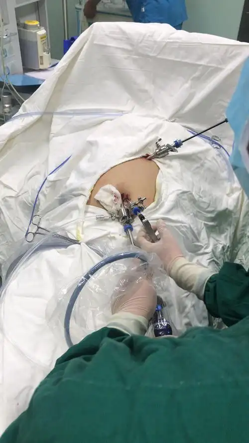 见微见智艺无止镜我院两孔腹腔镜微创手术已成常态化开展