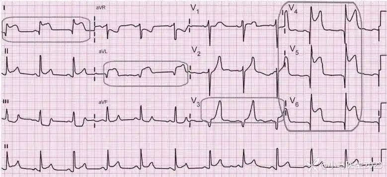 急性心肌梗死的心电图定位及诊断标准