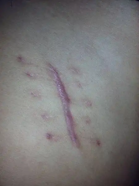 为什么我手术后的刀口一直是这个颜色?快三个月了唉 是阑尾炎的