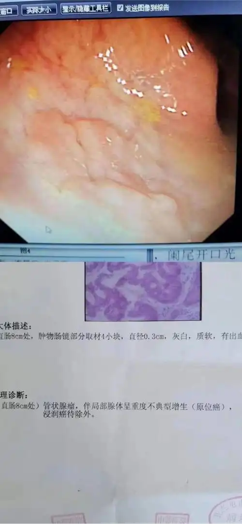 技术推介我院内镜室完成首例直肠原位癌经内镜粘膜下剥离术esd