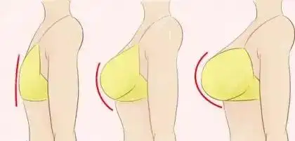 麦格假体隆胸的优缺点丰胸手感好维持时间久但价格略贵