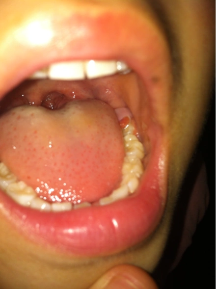 女儿5岁半下颌最里面牙龈有点肿还长了个红色小肉球一直喊疼怎么回事