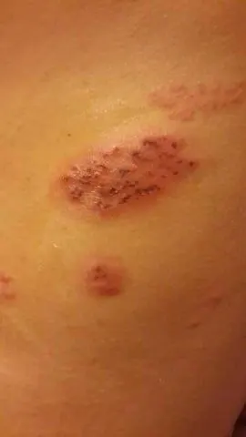 问:皮肤科医生帮忙给看看 去泡温泉回来后皮肤就痒